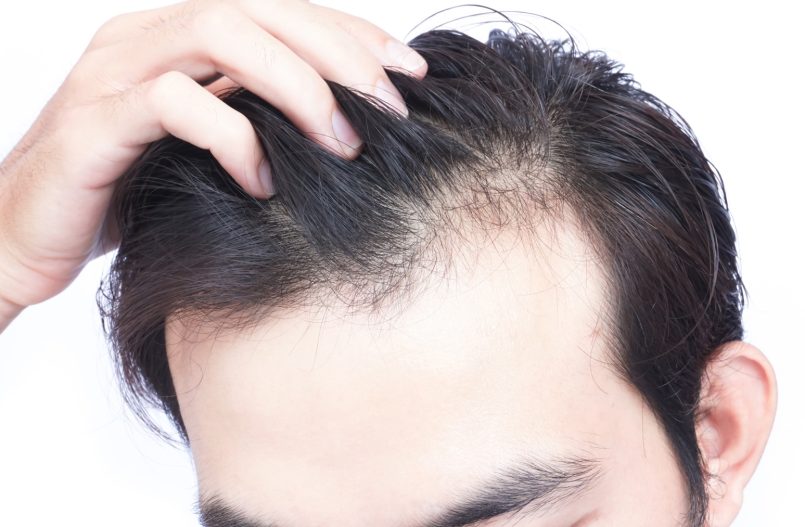 Thinning And Balding Of Hair Can Be Treat